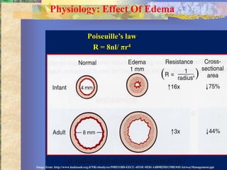Physiology: Effect Of Edema

                                Poiseuille’s law
                                 R = 8nl/ πr4




                   If radius is halved, resistance increases 16 x
Image from: http://www.hadassah.org.il/NR/rdonlyres/59B531BD-EECC-4FOE-9E81-14B9B29D139B1945/AirwayManagement.ppt
 