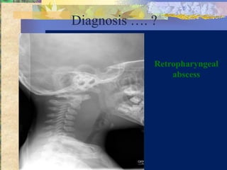 Diagnosis …. ?


             Retropharyngeal
                 abscess
 