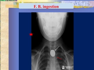 F. B. ingestion
 