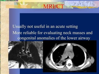 MRI/CT


Usually not useful in an acute setting
More reliable for evaluating neck masses and
  congenital anomalies of the lower airway
  and vascular system
 