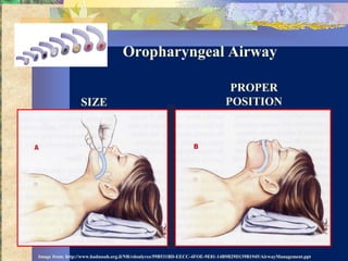 Oropharyngeal Airway

                                                                              PROPER
                 SIZE                                                        POSITION




Image from: http://www.hadassah.org.il/NR/rdonlyres/59B531BD-EECC-4FOE-9E81-14B9B29D139B1945/AirwayManagement.ppt
 