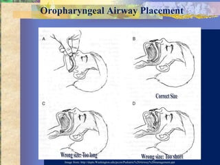 Oropharyngeal Airway Placement




     Image from: http://depts.Washington.edu/pccm/Pediatric%20Airway%20management.ppt
 