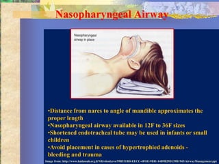 Nasopharyngeal Airway




 •Distance from nares to angle of mandible approximates the
 proper length
 •Nasopharyngeal airway available in 12F to 36F sizes
 •Shortened endotracheal tube may be used in infants or small
 children
 •Avoid placement in cases of hypertrophied adenoids -
 bleeding and trauma
Image from: http://www.hadassah.org.il/NR/rdonlyres/59B531BD-EECC-4FOE-9E81-14B9B29D139B1945/AirwayManagement.ppt
 