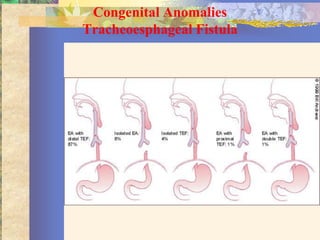 Congenital Anomalies
Tracheoesphageal Fistula
 