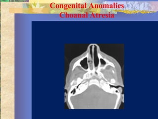 Congenital Anomalies
  Choanal Atresia
 