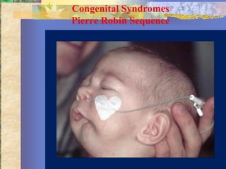 Congenital Syndromes
Pierre Robin Sequence
 
