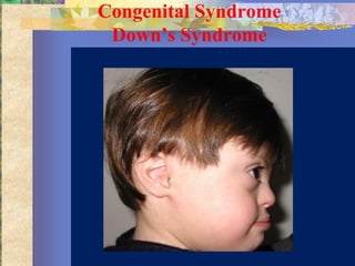Congenital Syndrome
 Down’s Syndrome
 