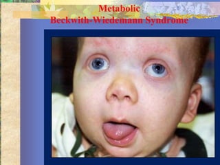 Metabolic
Beckwith-Wiedemann Syndrome
 