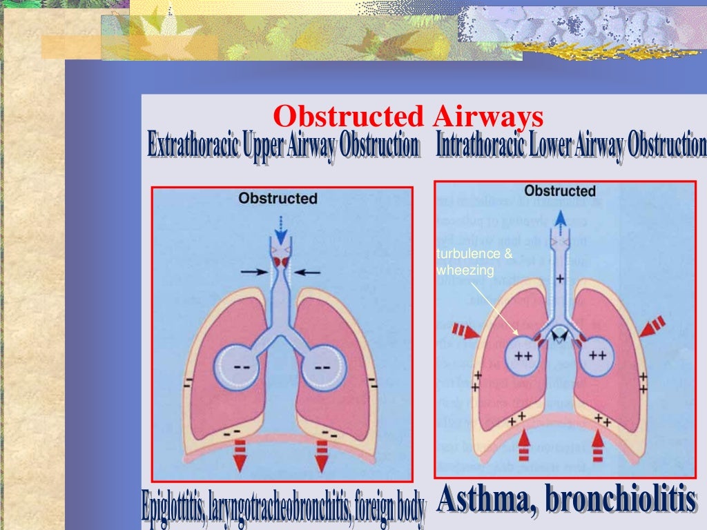 Pediatric airway obstruction