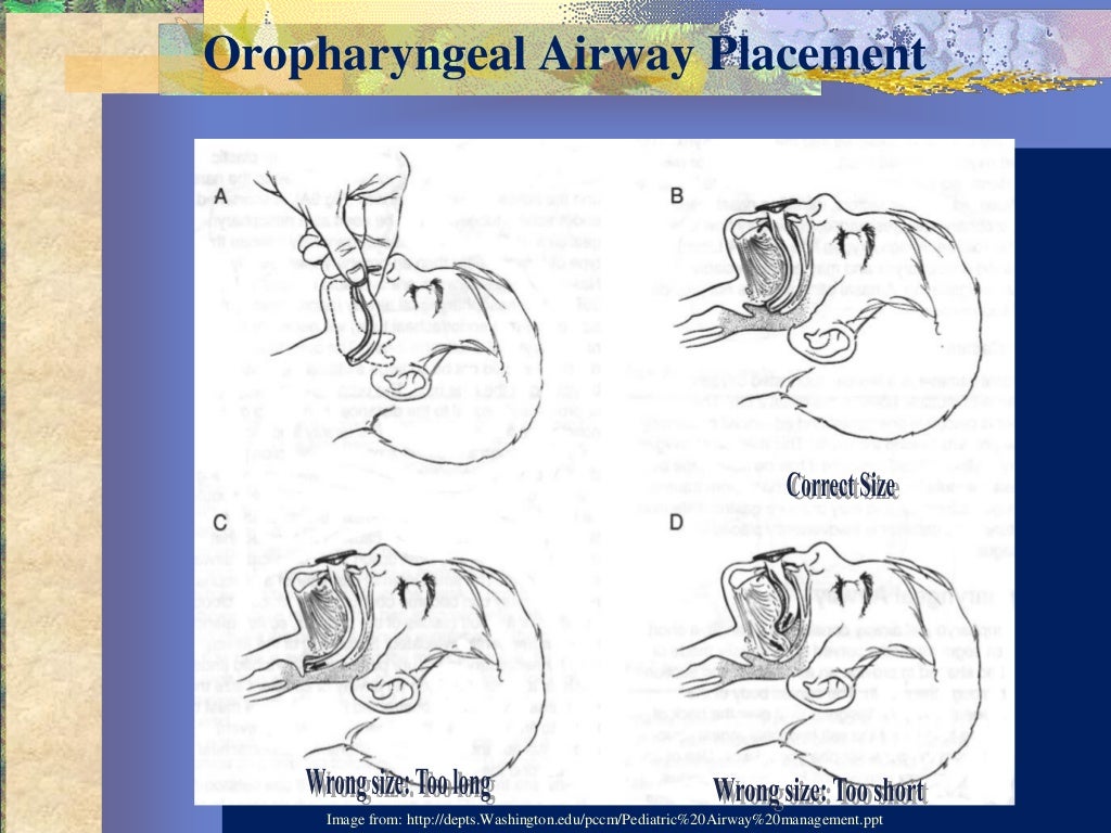 Pediatric airway obstruction