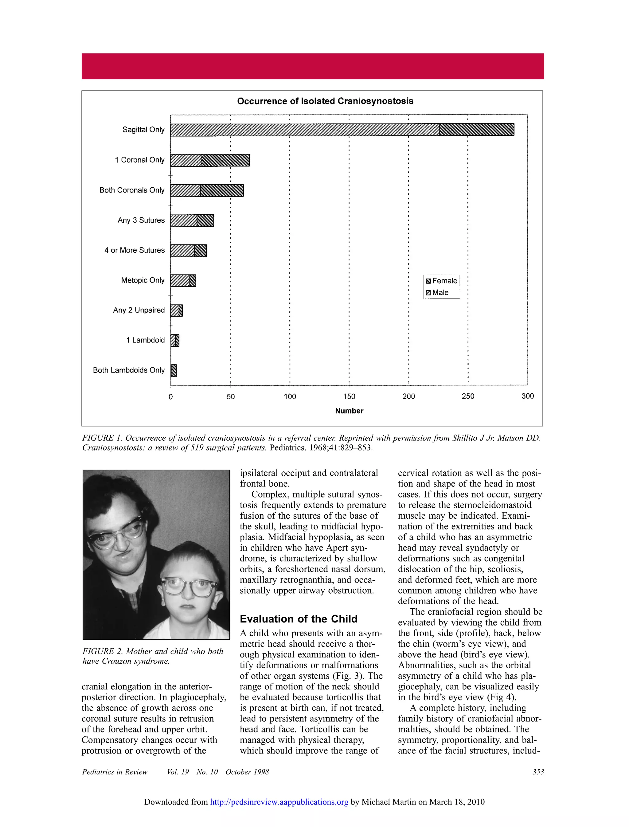 Pediatrics in Review Vol. 19 No. 10 October 1998 353
cranial elongation in the anterior-
posterior direction. In plagiocephaly,
the absence of growth across one
coronal suture results in retrusion
of the forehead and upper orbit.
Compensatory changes occur with
protrusion or overgrowth of the
ipsilateral occiput and contralateral
frontal bone.
Complex, multiple sutural synos-
tosis frequently extends to premature
fusion of the sutures of the base of
the skull, leading to midfacial hypo-
plasia. Midfacial hypoplasia, as seen
in children who have Apert syn-
drome, is characterized by shallow
orbits, a foreshortened nasal dorsum,
maxillary retrognanthia, and occa-
sionally upper airway obstruction.
Evaluation of the Child
A child who presents with an asym-
metric head should receive a thor-
ough physical examination to iden-
tify deformations or malformations
of other organ systems (Fig. 3). The
range of motion of the neck should
be evaluated because torticollis that
is present at birth can, if not treated,
lead to persistent asymmetry of the
head and face. Torticollis can be
managed with physical therapy,
which should improve the range of
cervical rotation as well as the posi-
tion and shape of the head in most
cases. If this does not occur, surgery
to release the sternocleidomastoid
muscle may be indicated. Exami-
nation of the extremities and back
of a child who has an asymmetric
head may reveal syndactyly or
deformations such as congenital
dislocation of the hip, scoliosis,
and deformed feet, which are more
common among children who have
deformations of the head.
The craniofacial region should be
evaluated by viewing the child from
the front, side (profile), back, below
the chin (worm’s eye view), and
above the head (bird’s eye view).
Abnormalities, such as the orbital
asymmetry of a child who has pla-
giocephaly, can be visualized easily
in the bird’s eye view (Fig 4).
A complete history, including
family history of craniofacial abnor-
malities, should be obtained. The
symmetry, proportionality, and bal-
ance of the facial structures, includ-
FIGURE 1. Occurrence of isolated craniosynostosis in a referral center. Reprinted with permission from Shillito J Jr, Matson DD.
Craniosynostosis: a review of 519 surgical patients. Pediatrics. 1968;41:829–853.
FIGURE 2. Mother and child who both
have Crouzon syndrome.
by Michael Martin on March 18, 2010http://pedsinreview.aappublications.orgDownloaded from
 