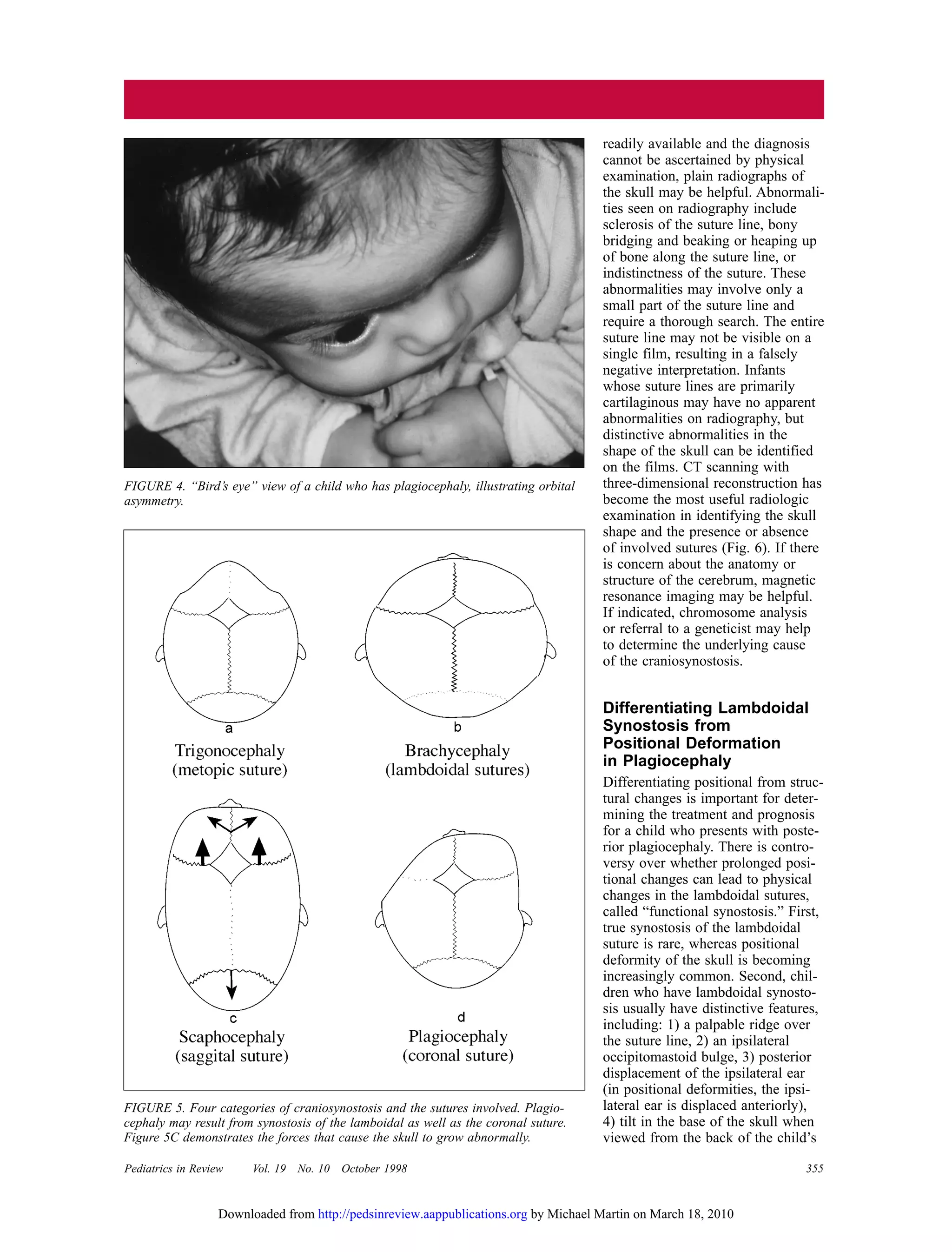 Pediatrics in Review Vol. 19 No. 10 October 1998 355
readily available and the diagnosis
cannot be ascertained by physical
examination, plain radiographs of
the skull may be helpful. Abnormali-
ties seen on radiography include
sclerosis of the suture line, bony
bridging and beaking or heaping up
of bone along the suture line, or
indistinctness of the suture. These
abnormalities may involve only a
small part of the suture line and
require a thorough search. The entire
suture line may not be visible on a
single film, resulting in a falsely
negative interpretation. Infants
whose suture lines are primarily
cartilaginous may have no apparent
abnormalities on radiography, but
distinctive abnormalities in the
shape of the skull can be identified
on the films. CT scanning with
three-dimensional reconstruction has
become the most useful radiologic
examination in identifying the skull
shape and the presence or absence
of involved sutures (Fig. 6). If there
is concern about the anatomy or
structure of the cerebrum, magnetic
resonance imaging may be helpful.
If indicated, chromosome analysis
or referral to a geneticist may help
to determine the underlying cause
of the craniosynostosis.
Differentiating Lambdoidal
Synostosis from
Positional Deformation
in Plagiocephaly
Differentiating positional from struc-
tural changes is important for deter-
mining the treatment and prognosis
for a child who presents with poste-
rior plagiocephaly. There is contro-
versy over whether prolonged posi-
tional changes can lead to physical
changes in the lambdoidal sutures,
called “functional synostosis.” First,
true synostosis of the lambdoidal
suture is rare, whereas positional
deformity of the skull is becoming
increasingly common. Second, chil-
dren who have lambdoidal synosto-
sis usually have distinctive features,
including: 1) a palpable ridge over
the suture line, 2) an ipsilateral
occipitomastoid bulge, 3) posterior
displacement of the ipsilateral ear
(in positional deformities, the ipsi-
lateral ear is displaced anteriorly),
4) tilt in the base of the skull when
viewed from the back of the child’s
FIGURE 4. “Bird’s eye” view of a child who has plagiocephaly, illustrating orbital
asymmetry.
FIGURE 5. Four categories of craniosynostosis and the sutures involved. Plagio-
cephaly may result from synostosis of the lamboidal as well as the coronal suture.
Figure 5C demonstrates the forces that cause the skull to grow abnormally.
by Michael Martin on March 18, 2010http://pedsinreview.aappublications.orgDownloaded from
 