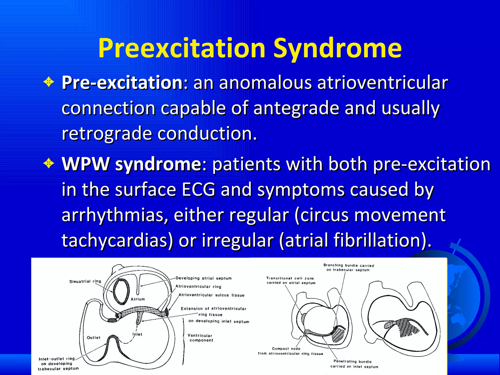 Preexcitation Syndrome Pre-excitation : an anomalous atrioventricular connection capable of antegrade and usually retrograde conduction.  WPW syndrome : patients with both pre-excitation in the surface ECG and symptoms caused by arrhythmias, either regular (circus movement tachycardias) or irregular (atrial fibrillation).  