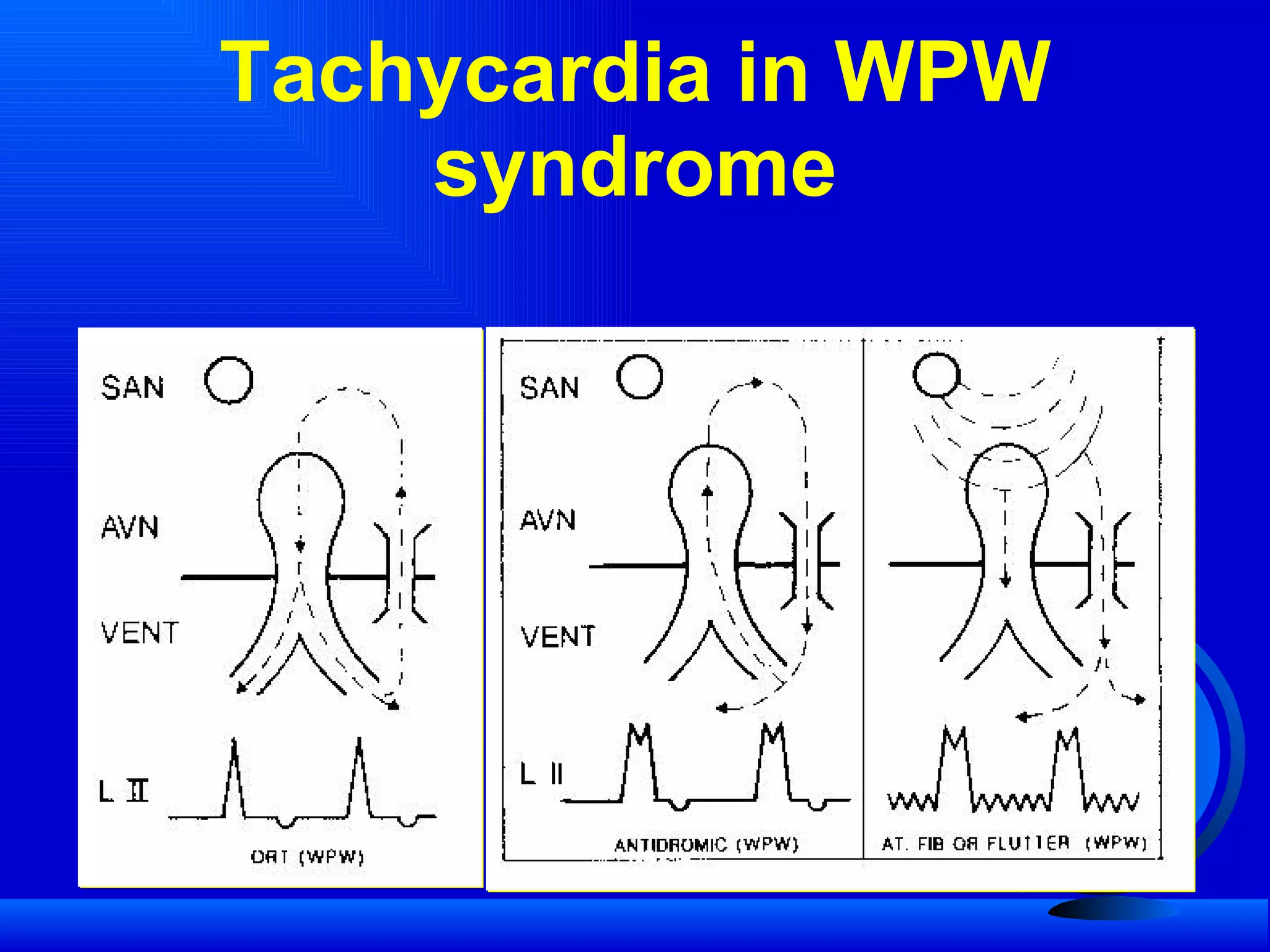 Tachycardia in WPW syndrome 