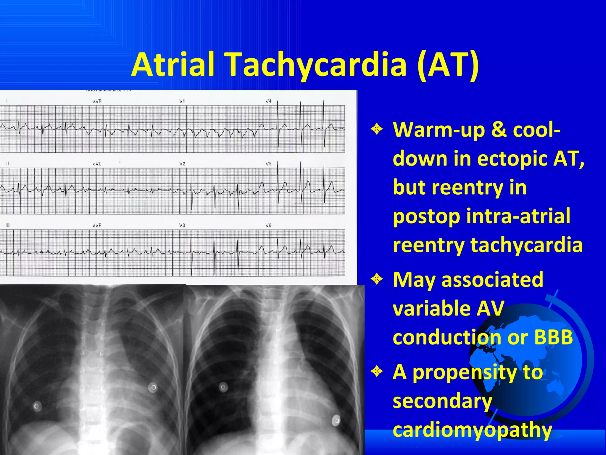 Atrial Tachycardia (AT) Warm-up & cool-down in ectopic AT, but reentry in postop intra-atrial reentry tachycardia May associated variable AV conduction or BBB A propensity to secondary cardiomyopathy 