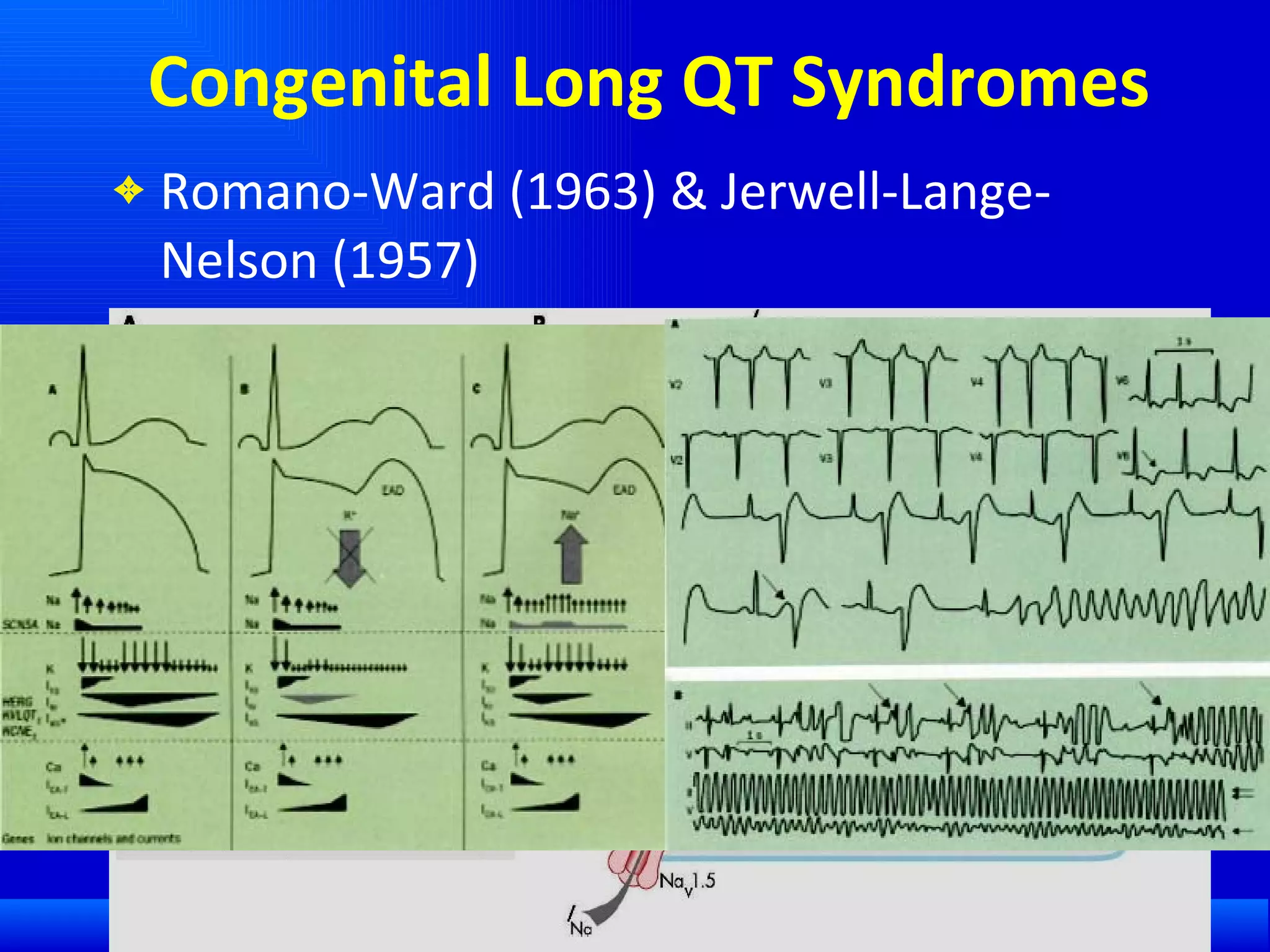 Congenital Long QT Syndromes Romano-Ward (1963) & Jerwell-Lange-Nelson (1957) Ion channel defects 