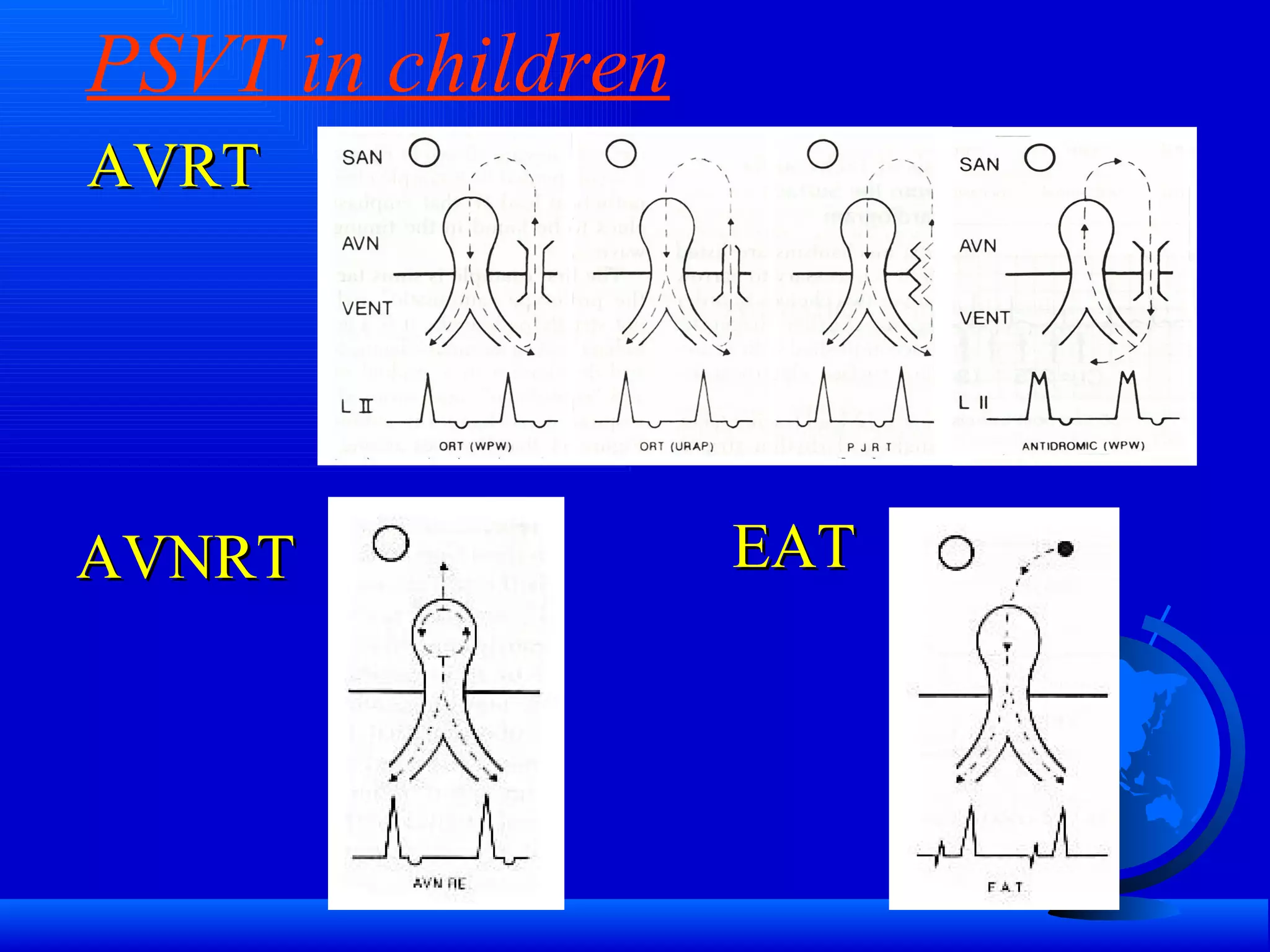 PSVT in children AVRT AVNRT EAT 