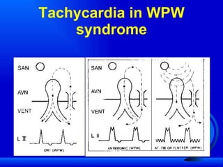 Tachycardia in WPW syndrome 