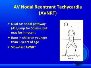 AV Nodal Reentrant Tachycardia (AVNRT) Dual AV nodal pathway (AH jump for 50 ms), but may be innocent Rare in children younger than 5 years of age Slow-fast AVNRT  