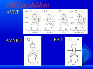 PSVT in children AVRT AVNRT EAT 