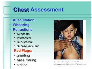 Chest Assessment
• Auscultation
• Wheezing
• Retractions
  •   Subcostal
  •   Intercostal
  •   Sub-sternal
  •   Supra-clavicular
  Red Flags:
  • grunting
  • nasal flaring
  • stridor
 
