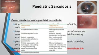 Paediatric Sarcoidosis
• Ocular manifestations in paediatric sarcoidosis:
oGranulomatous chronic anterior uveitis with mutton-fat KPs, iris
nodules.
oIntermediate uveitis with moderate-to-severe vitreous inflammation,
snowball and snow banking of pars plana region with inflammatory
exudates can be seen.
oposterior uveitis; Multiple choroidal granuloma or sarcoid tubercles,
periphlebitis with candle wax drippings
• Sometimes it is difficult to differentiate this clinical picture from JIA-
associated uveitis.
 