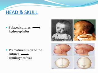HEAD & SKULL
 Splayed sutures
hydrocephalus
 Premature fusion of the
sutures
craniosynostosis
 