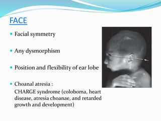 FACE
 Facial symmetry
 Any dysmorphism
 Position and flexibility of ear lobe
 Choanal atresia :
CHARGE syndrome (coloboma, heart
disease, atresia choanae, and retarded
growth and development)
 