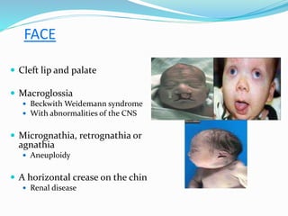 FACE
 Cleft lip and palate
 Macroglossia
 Beckwith Weidemann syndrome
 With abnormalities of the CNS
 Micrognathia, retrognathia or
agnathia
 Aneuploidy
 A horizontal crease on the chin
 Renal disease
 