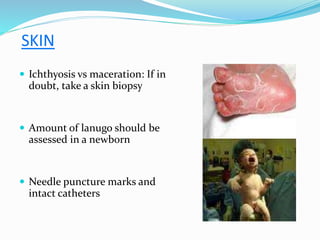 SKIN
 Ichthyosis vs maceration: If in
doubt, take a skin biopsy
 Amount of lanugo should be
assessed in a newborn
 Needle puncture marks and
intact catheters
 