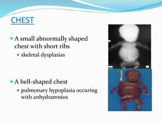 CHEST
 A small abnormally shaped
chest with short ribs
 skeletal dysplasias
 A bell-shaped chest
 pulmonary hypoplasia occuring
with anhydramnios
 