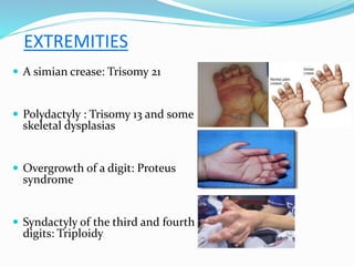 EXTREMITIES
 A simian crease: Trisomy 21
 Polydactyly : Trisomy 13 and some
skeletal dysplasias
 Overgrowth of a digit: Proteus
syndrome
 Syndactyly of the third and fourth
digits: Triploidy
 