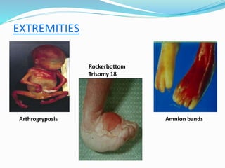 EXTREMITIES
Arthrogryposis
Rockerbottom
Trisomy 18
Amnion bands
 