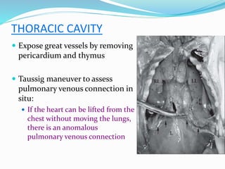 THORACIC CAVITY
 Expose great vessels by removing
pericardium and thymus
 Taussig maneuver to assess
pulmonary venous connection in
situ:
 If the heart can be lifted from the
chest without moving the lungs,
there is an anomalous
pulmonary venous connection
 