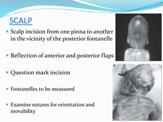SCALP
 Scalp incision from one pinna to another
in the vicinity of the posterior fontanelle
 Reflection of anterior and posterior flaps
 Question mark incision
 Fontanelles to be measured
 Examine sutures for orientation and
movability
 