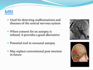 MRI
 Used for detecting malformations and
diseases of the central nervous system
 When consent for an autopsy is
refused, it provides a good alternative
 Potential tool in neonatal autopsy
 May replace conventional post mortem
in future
 