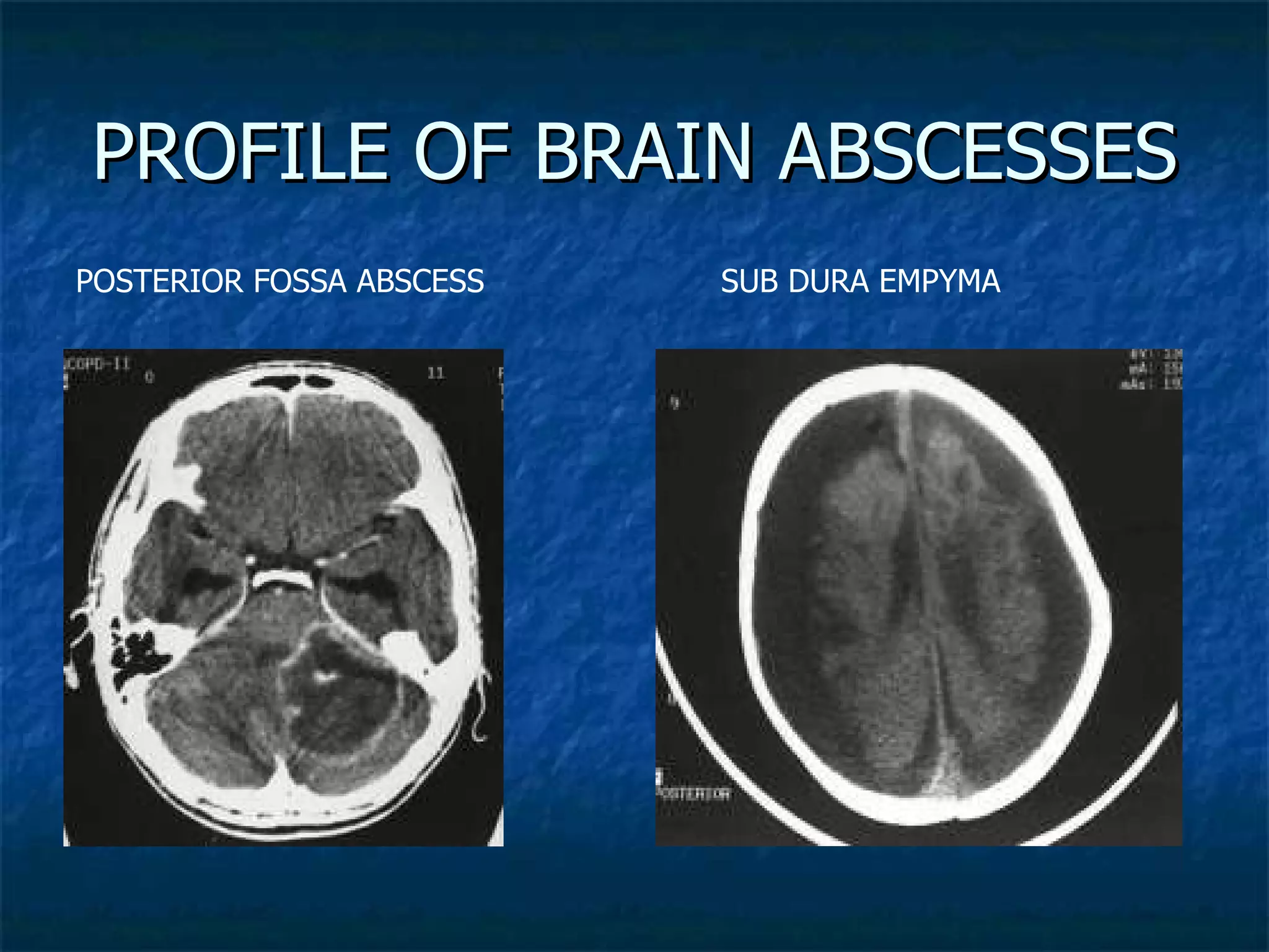What Is Brain Abscess Pediatric brain abscesses profile | PPT | Brain and Nervous System ...