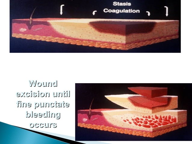 Pediatric burns | PPT | First Aid | Injuries