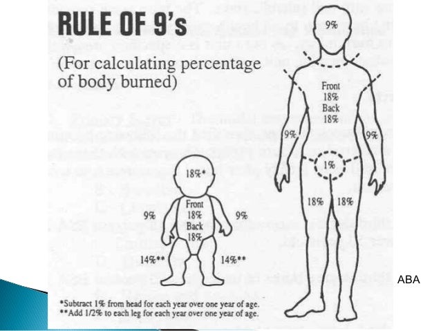 Burn Percentage Chart Rule Of 9