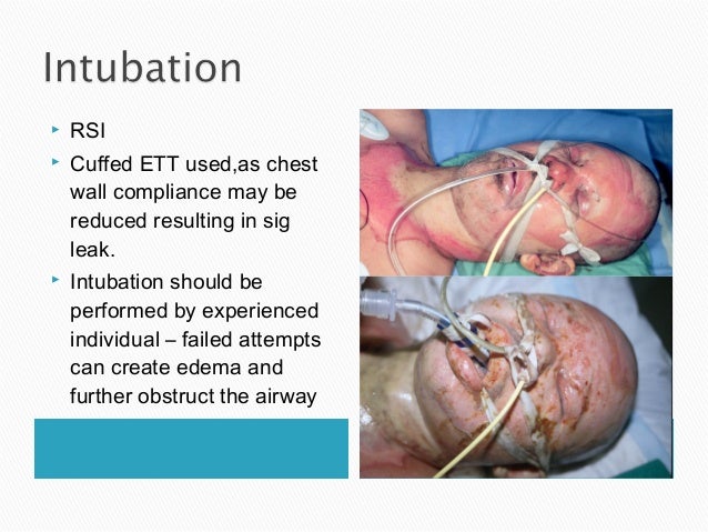 burn patients intubation burn patients intubation
