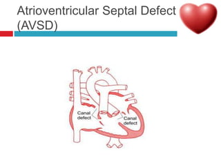Avsd Wave Common Cardiac disorders among Children.ppt