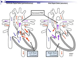 Increased PBF




Left Heart         Right Heart
 Overload            Overload
 