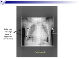 Pulm vasc
  markings
  equal in
 upper and
lower zones




              Cardiomegaly
 