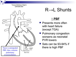 R→L Shunts
                                            ↑ PBF
                                    Presents more often
                                     with heart failure
                                     (except TGA)
                                    Pulmonary congestion
                                     worsens as neonatal
                                     PVR lowers
                                    Sats can be 93-94% if
There is unimpeded     Equal
                                     there is high PBF
PBF; thus, extreme   pressures
    pulmonary        here too
 overcirculation.
 