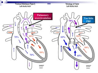 Pulmonary
      90%         overcirculation                     Too little
                                          70%           PBF




70%         99%                     60%         99%



                                                      99%

                      99%
            70%                                 60%
 
