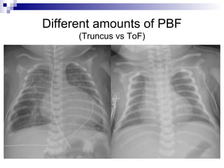 Different amounts of PBF
      (Truncus vs ToF)
 