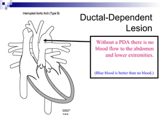 Ductal-Dependent
          Lesion
   Without a PDA there is no
   blood flow to the abdomen
       and lower extremities.


   (Blue blood is better than no blood.)
 