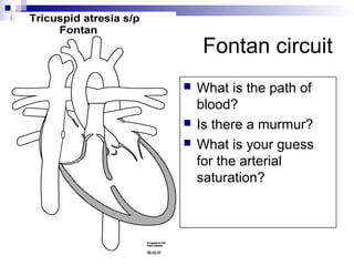 Fontan circuit
   What is the path of
    blood?
   Is there a murmur?
   What is your guess
    for the arterial
    saturation?
 