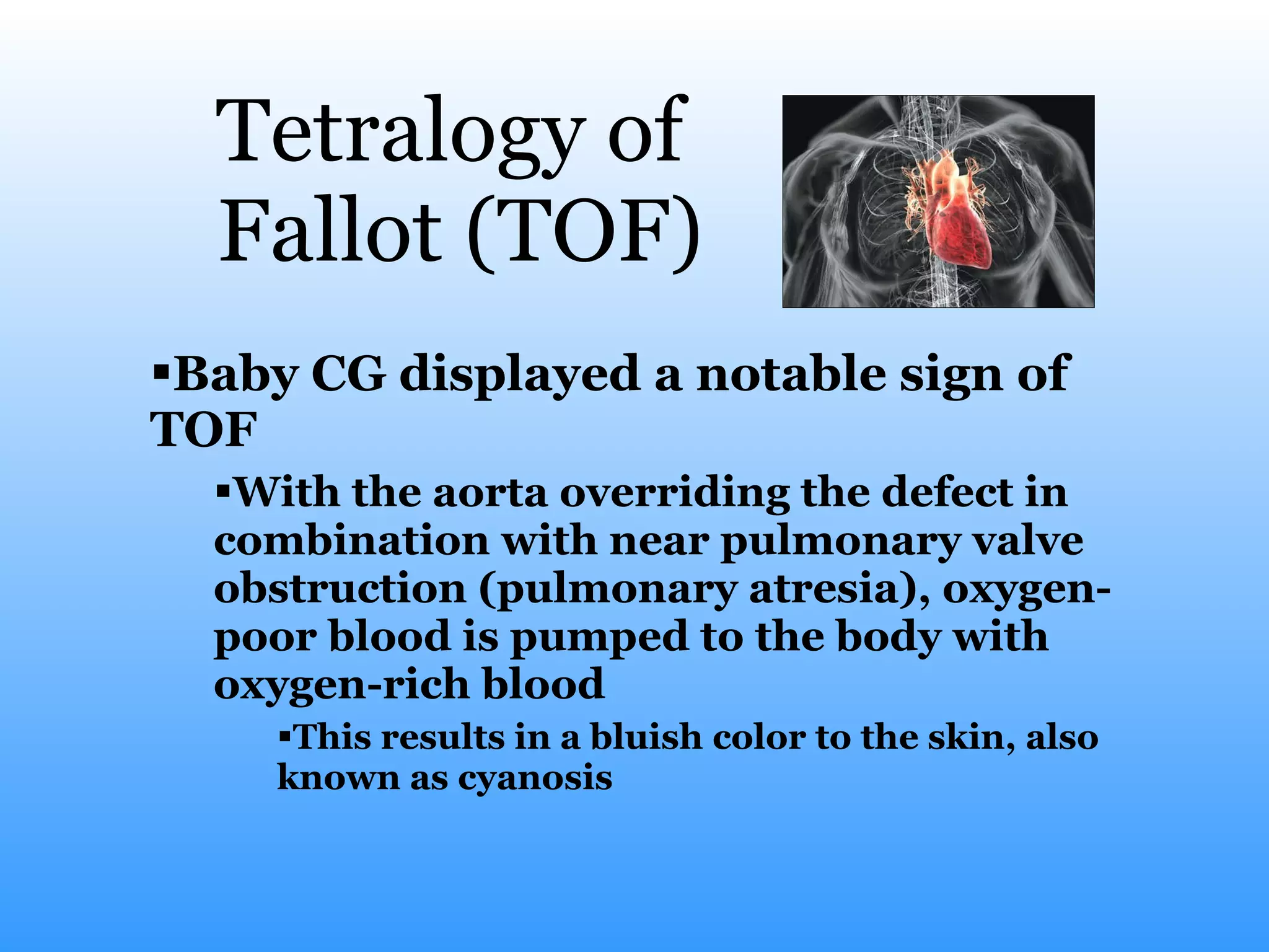Tetralogy of  Fallot (TOF) Baby CG displayed a notable sign of TOF With the aorta overriding the defect in combination with near pulmonary valve obstruction (pulmonary atresia), oxygen-poor blood is pumped to the body with oxygen-rich blood This results in a bluish color to the skin, also known as cyanosis  