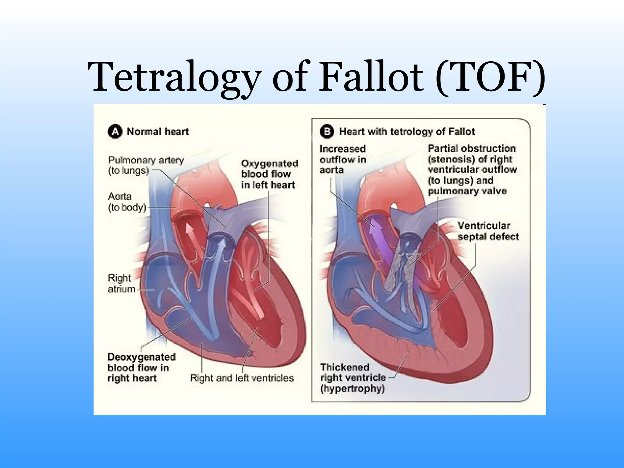 Tetralogy of Fallot (TOF) 
